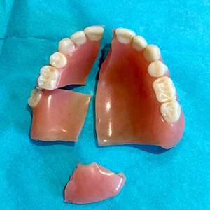 Denture Fracture